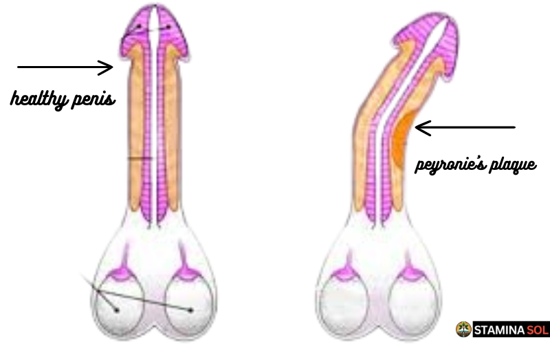 image of an healthy penis and an image of a penis infected by peyronie's disease , showing the difference